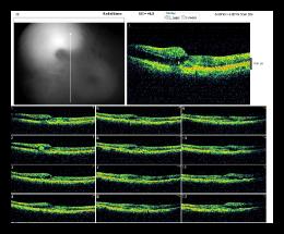 RADIAL LINE OD